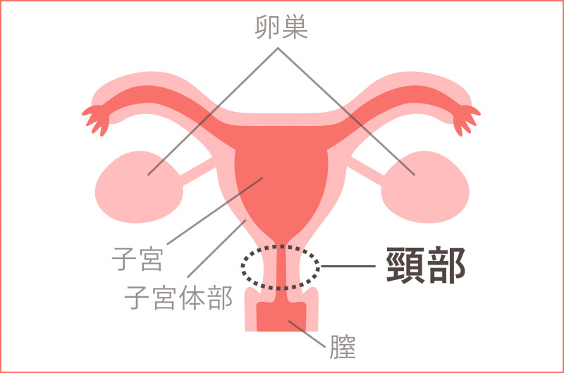 子宮頸がんは子宮の入り口に出来るがんです
